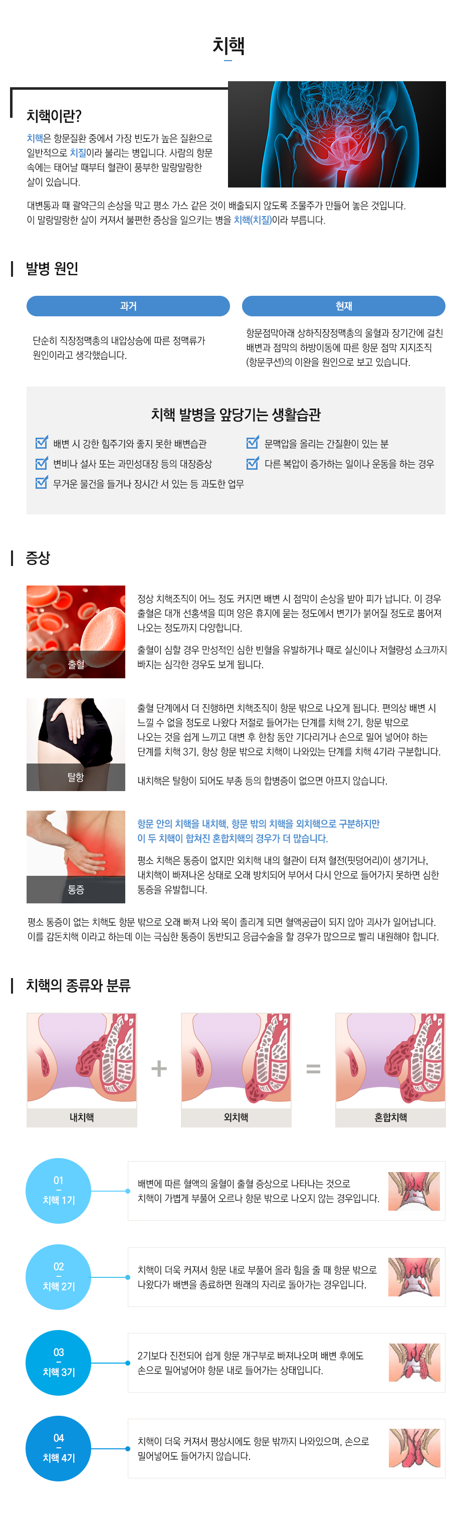 치핵