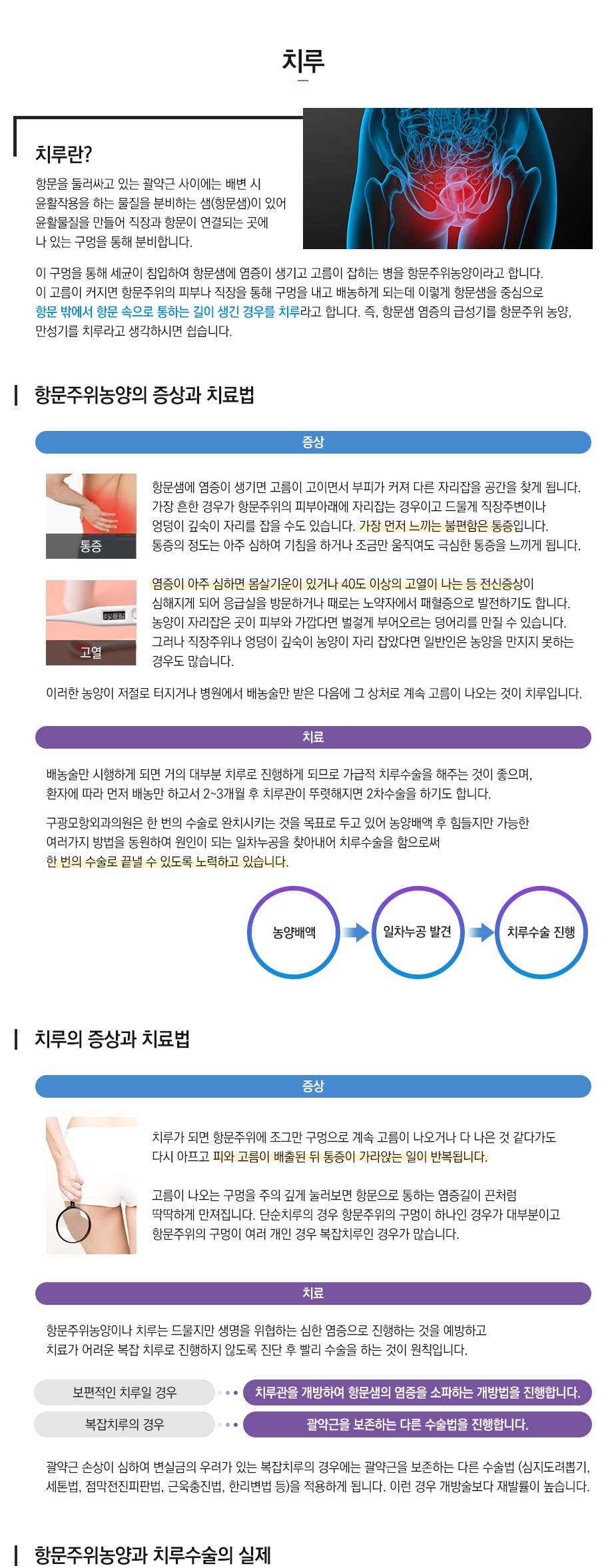 치루
